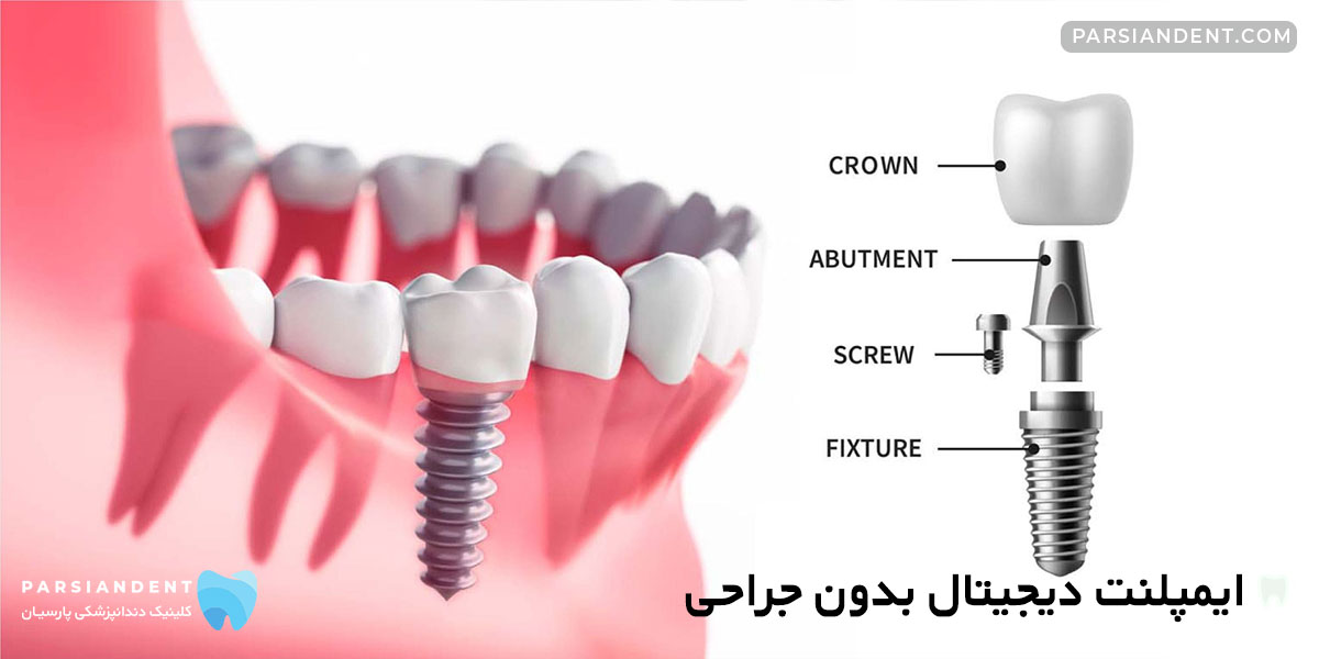 ایمپلنت دیجیتال بدون درد