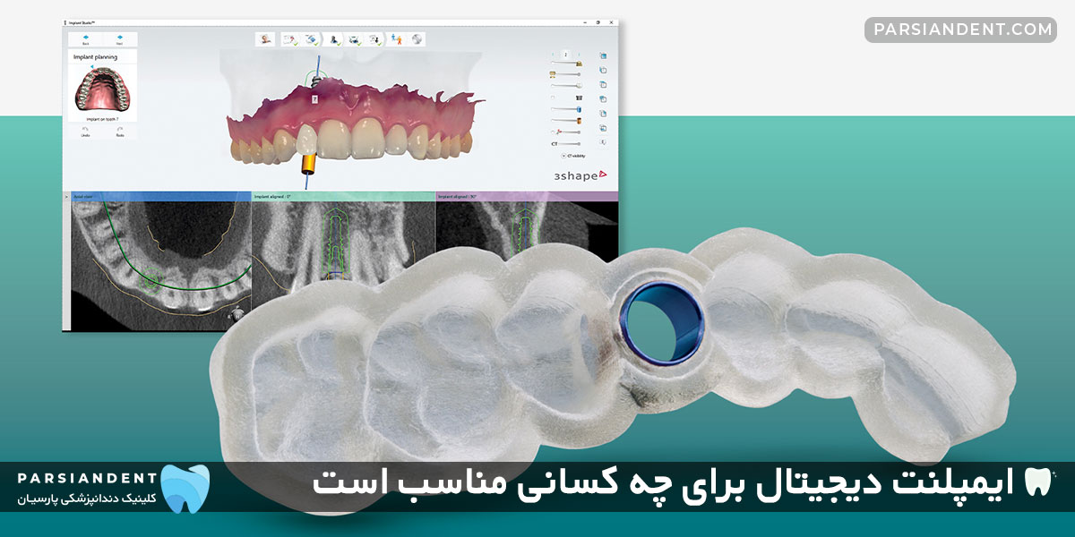  ایمپلنت دیجیتال برای چه افرادی مناسب است؟