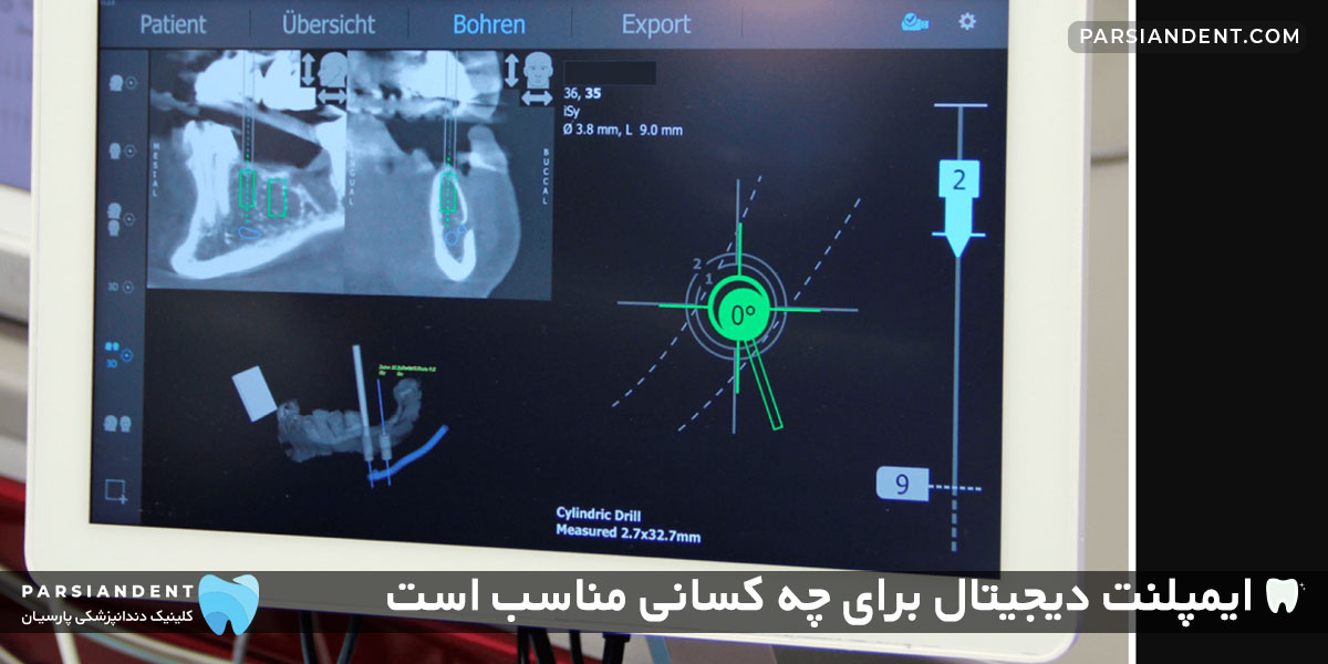 ایمپلنت دیجیتال برای چه کسانی مناسب است