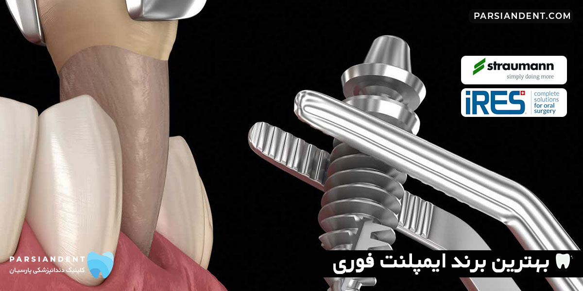 بهترین برند ایمپلنت فوری
