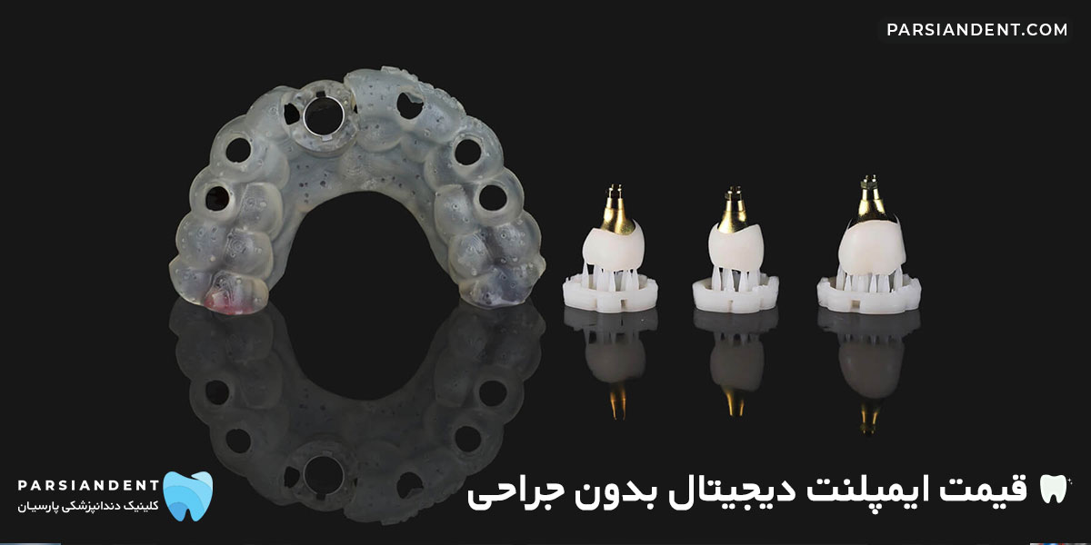 قیمت ایمپلنت دیجیتال بدون جراحی