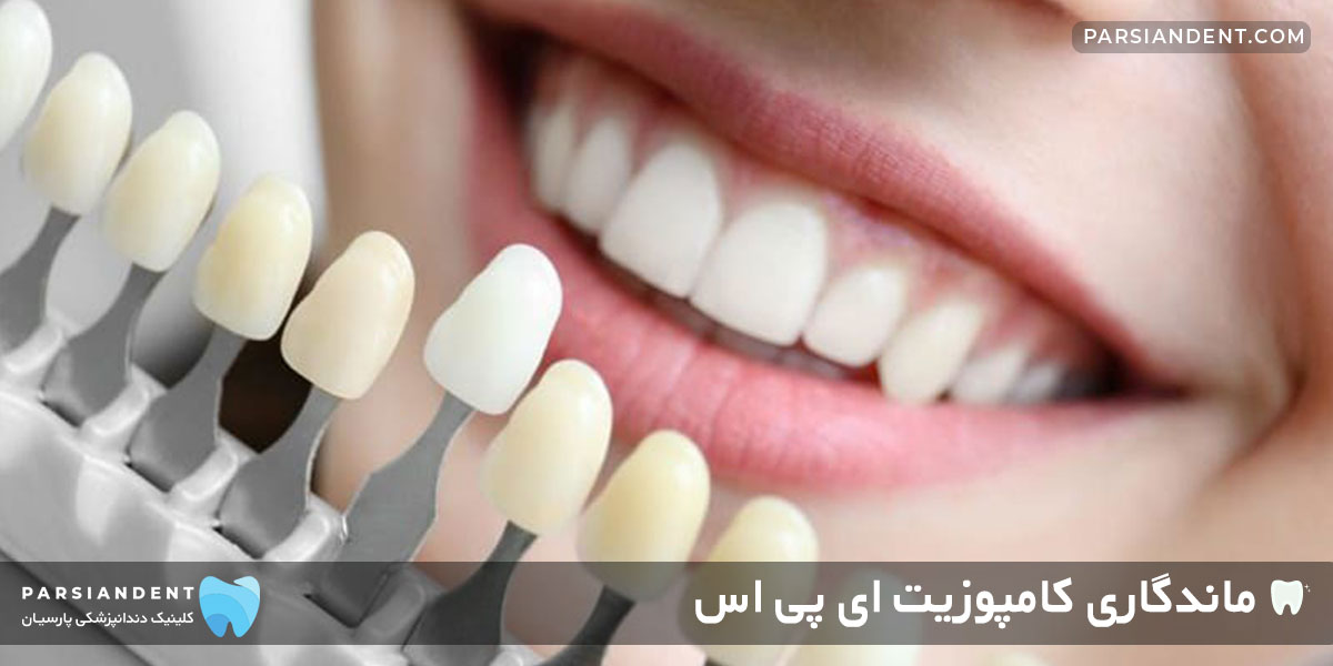 ماندگاری کامپوزیت ips