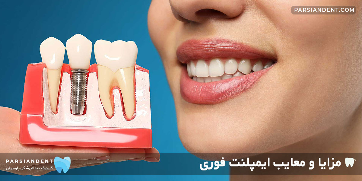 مزایا و معایب ایمپلنت فوری