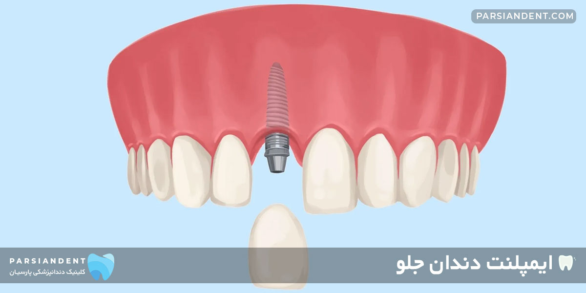 انجام ایمپلنت دندان جلو