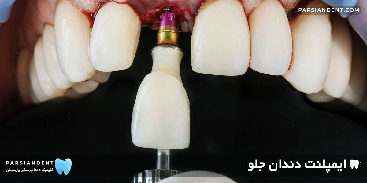 ایمپلنت دندان جلو