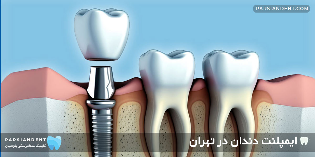 ایمپلنت دندان در تهران