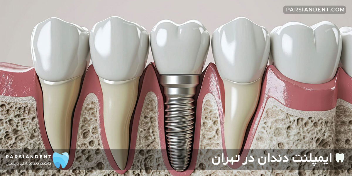 ایمپلنت دندان در شرق تهران