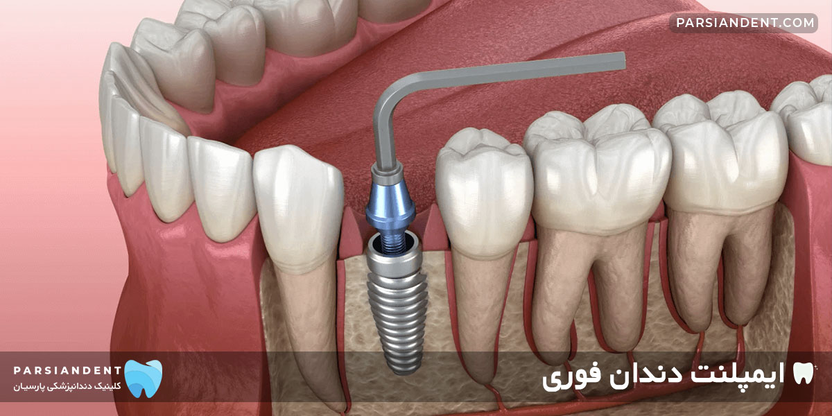 ایمپلنت دندان فوری