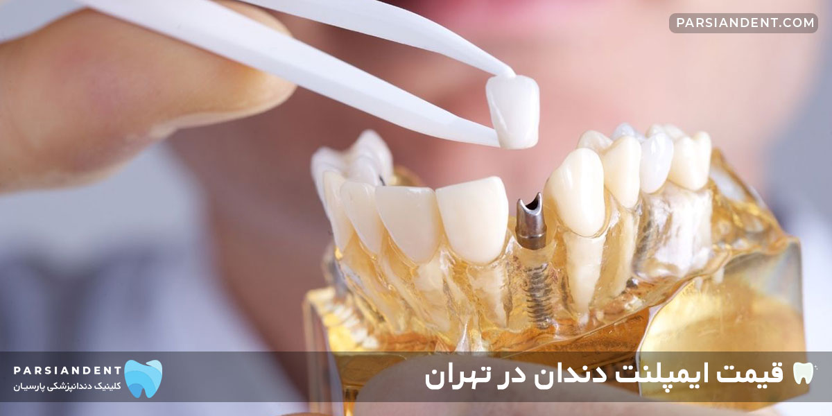 قیمت ایمپلنت دندان در تهران