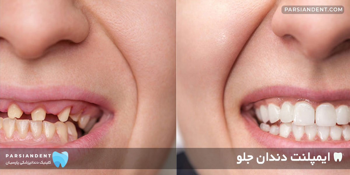مراحل ایمپلنت دندان جلو