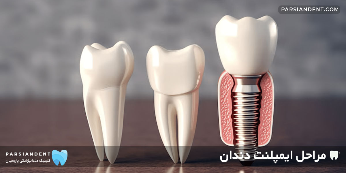 مراحل ایمپلنت دندان