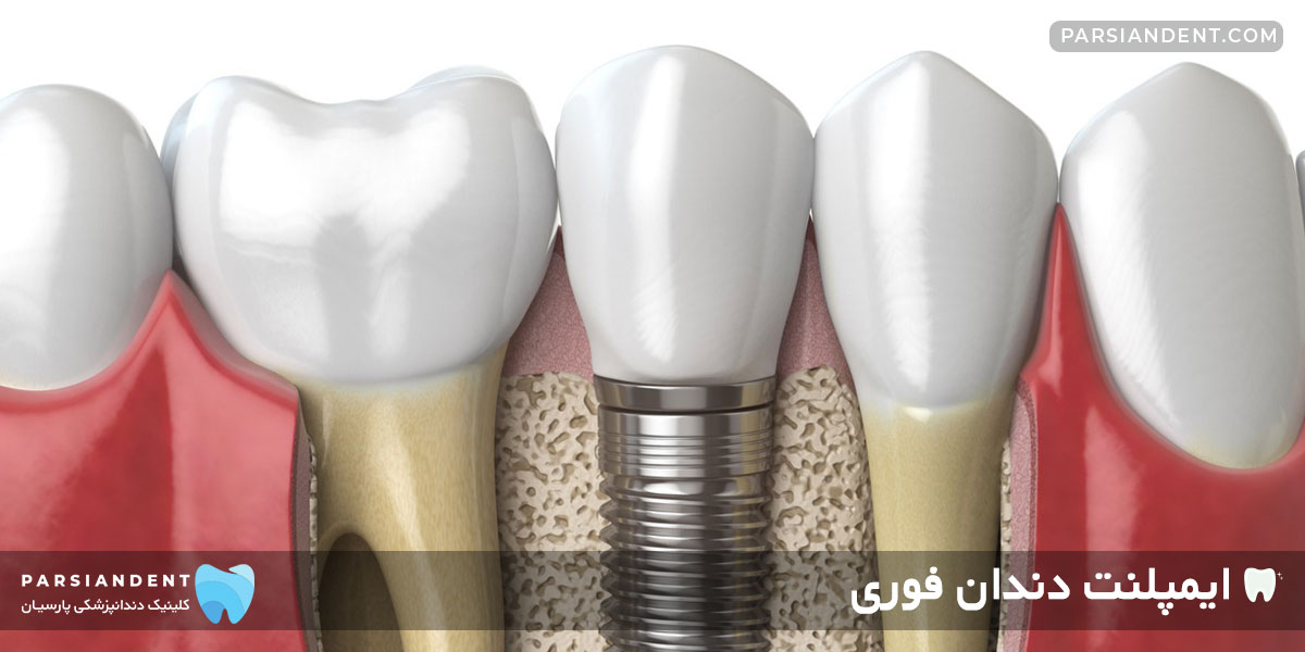 مراحل ایمپلنت فوری دندان