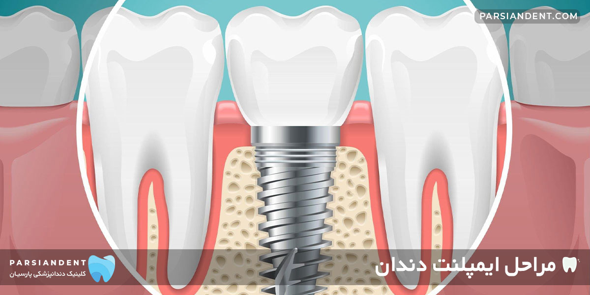 مراحل کاشت ایمپلنت دندان