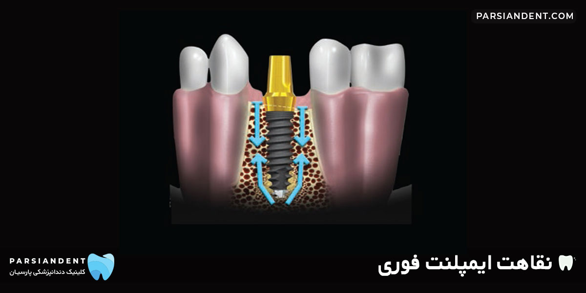 نقاهت ایمپلنت فوری