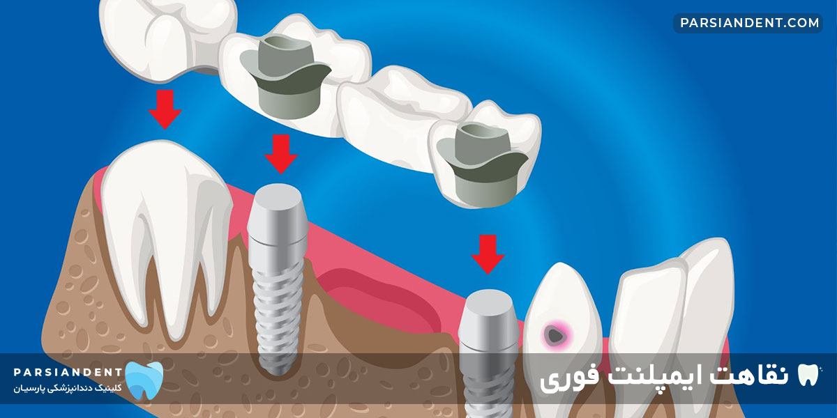 نقاهت ایمپلنت فوری دندان