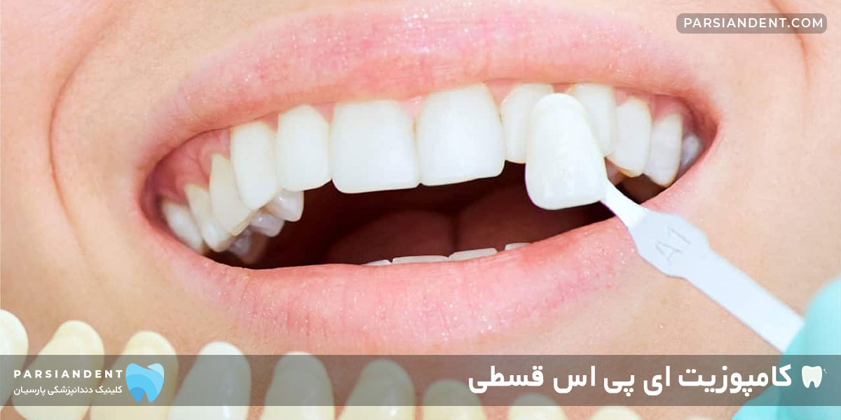 کامپوزیت ای پی اس قسطی