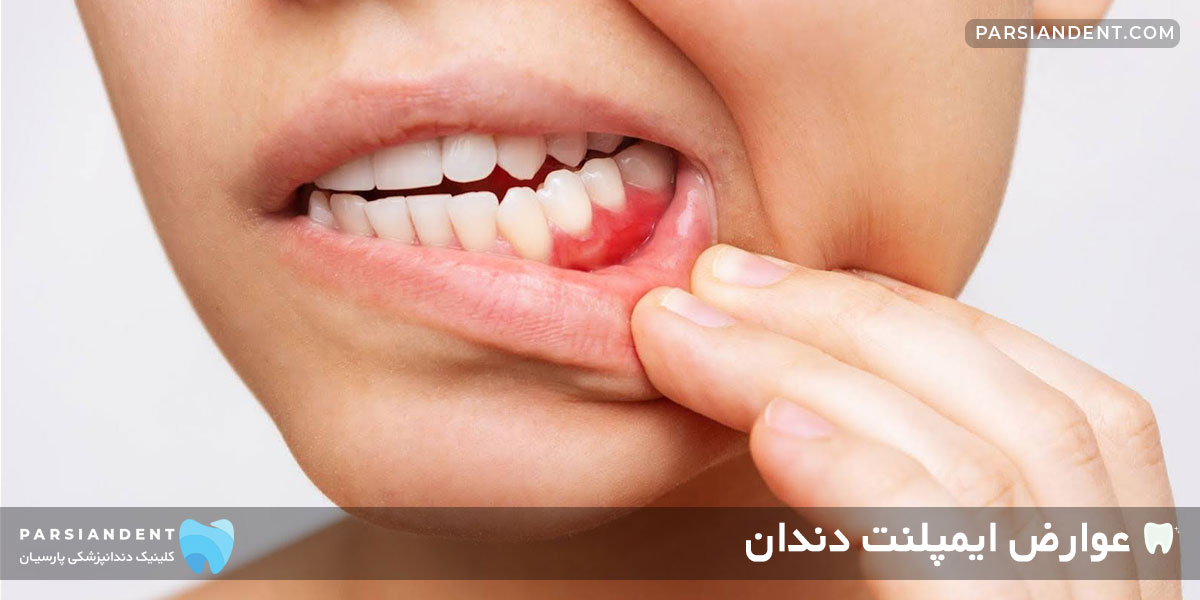  عوارض کاشت ایمپلنت دندان