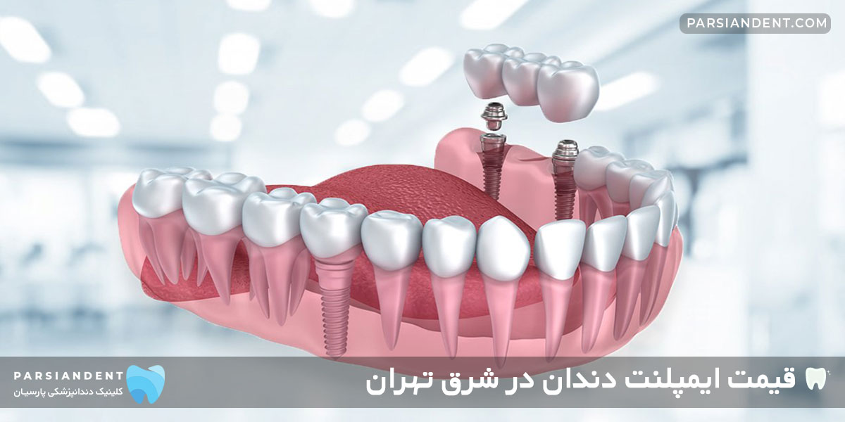 dental implant tehran price