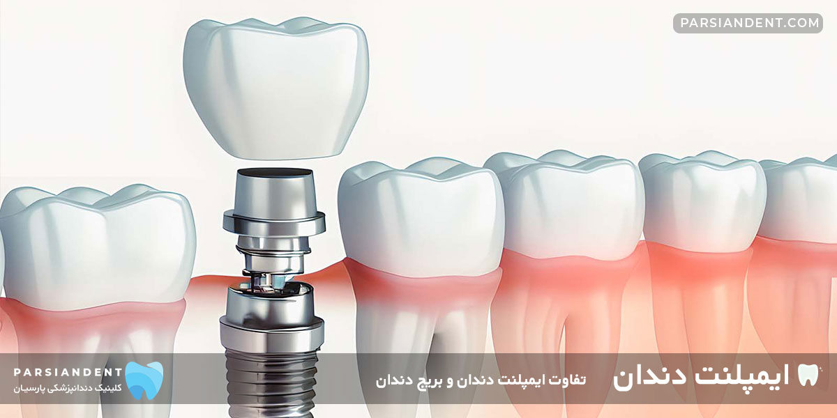 ایمپلنت دندان Dental Implants