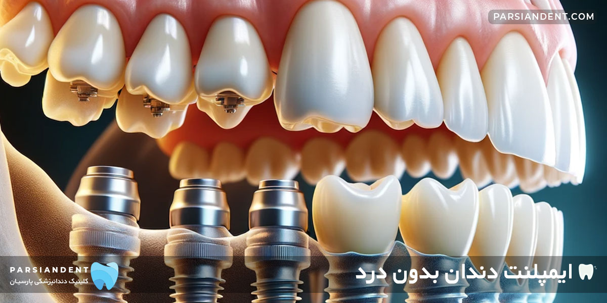 ایمپلنت دندان بدون درد