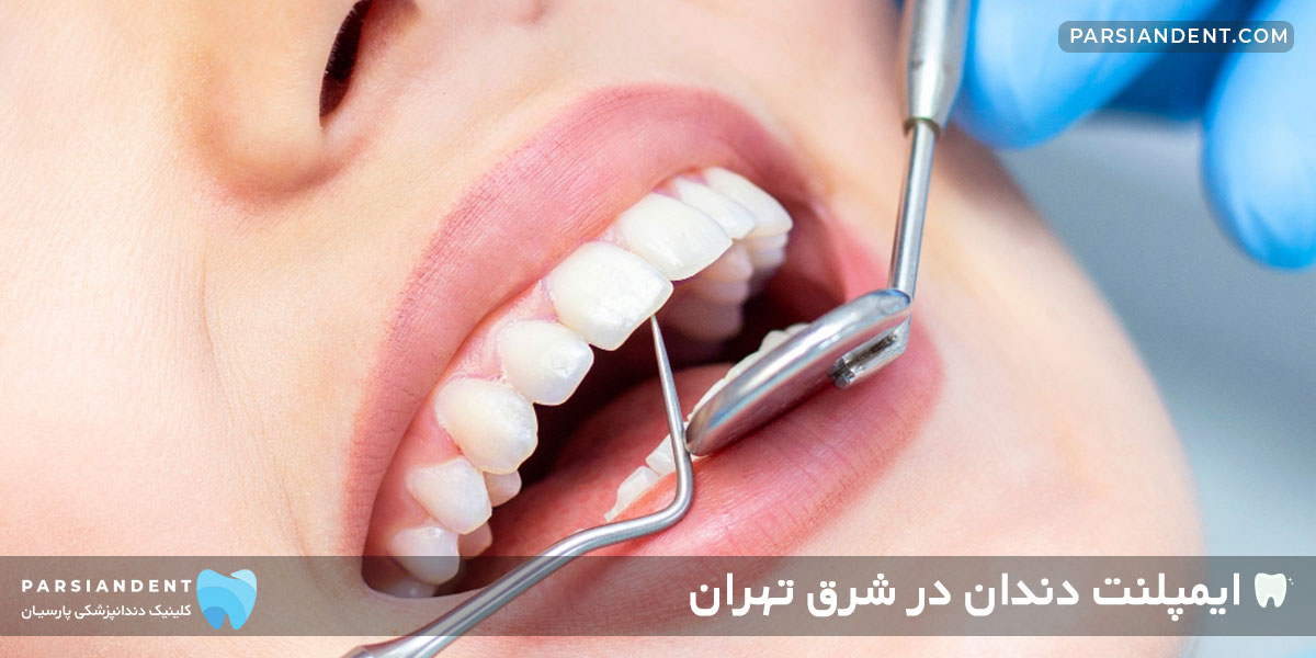ایمپلنت دندان در شرق تهران