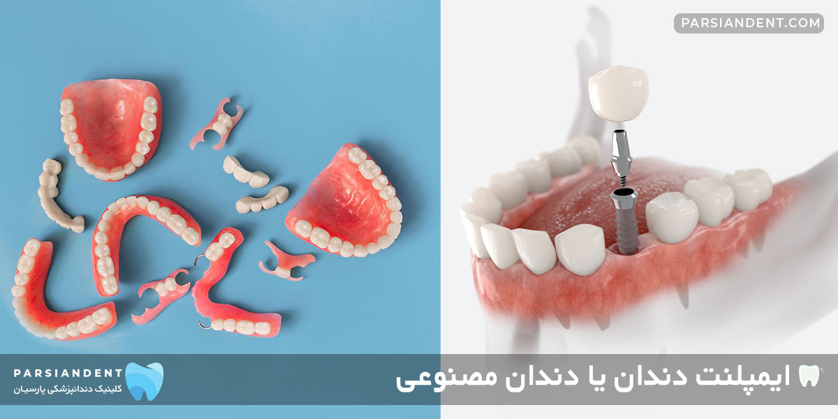 ایمپلنت دندان یا دندان مصنوعی