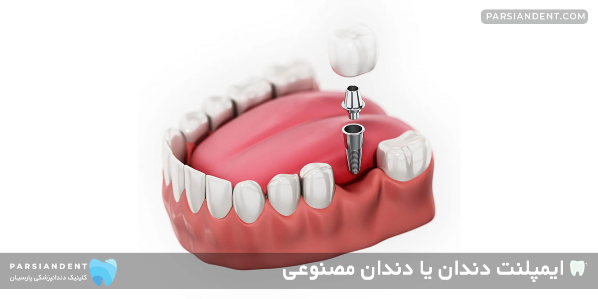 ایمپلنت دندان