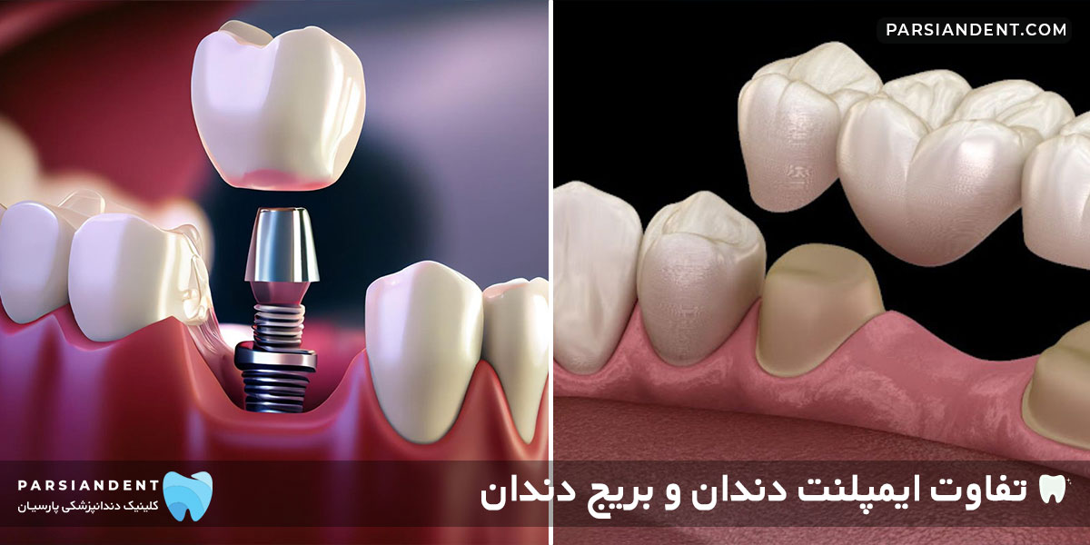 تفاوت ایمپلنت دندان و بریج دندان