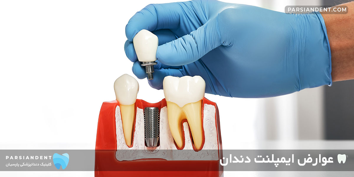 عوارض ایمپلنت دندان
