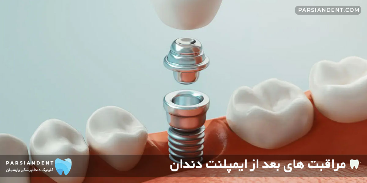 مراقبت بعد از کاشت ایمپلنت دندان