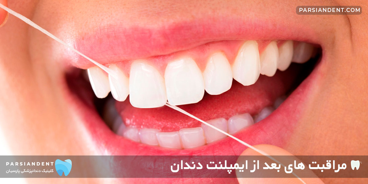 مراقبت های ایمپلنت دندان