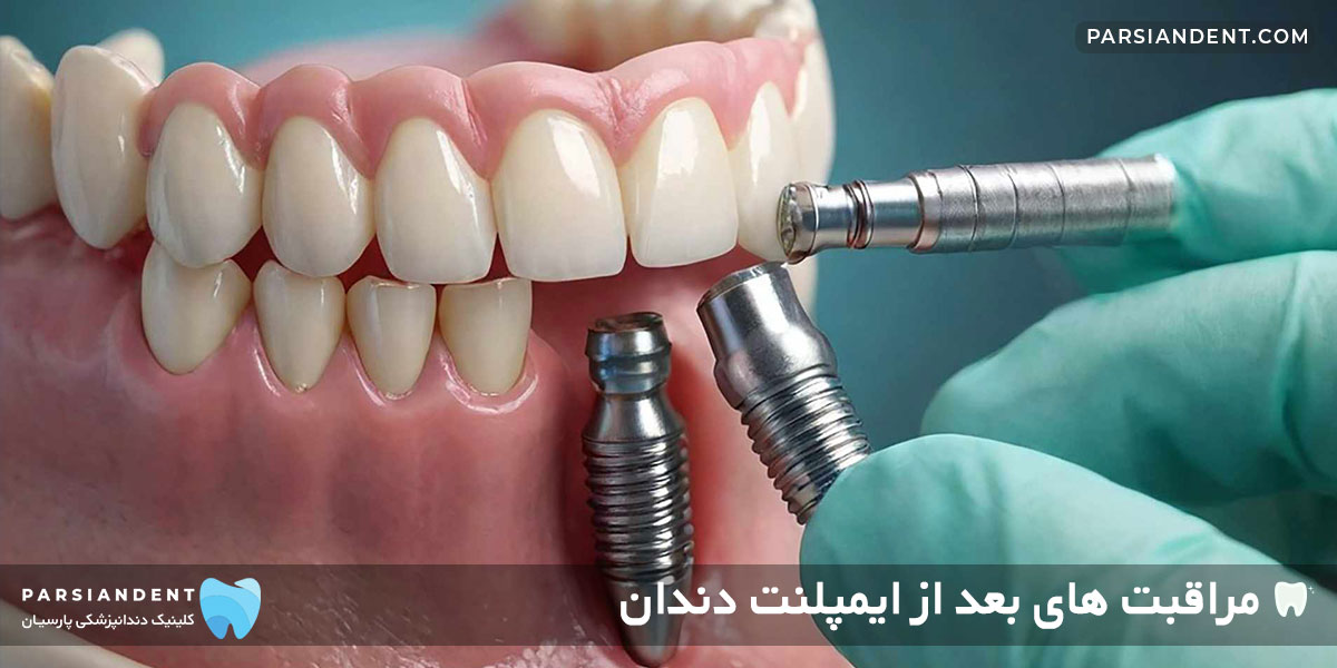 مراقبت های بعد از ایمپلنت دندان