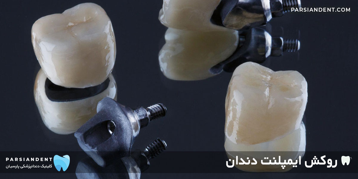 روکش ایمپلنت دندان