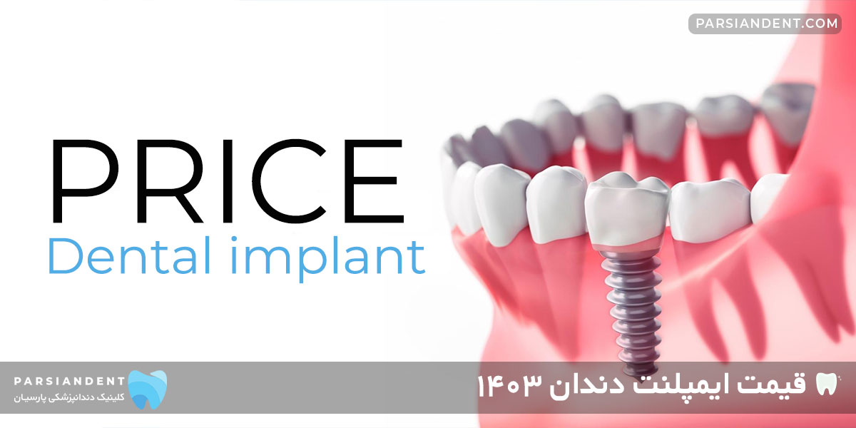 قیمت ایمپلنت دندان ۱۴۰۳