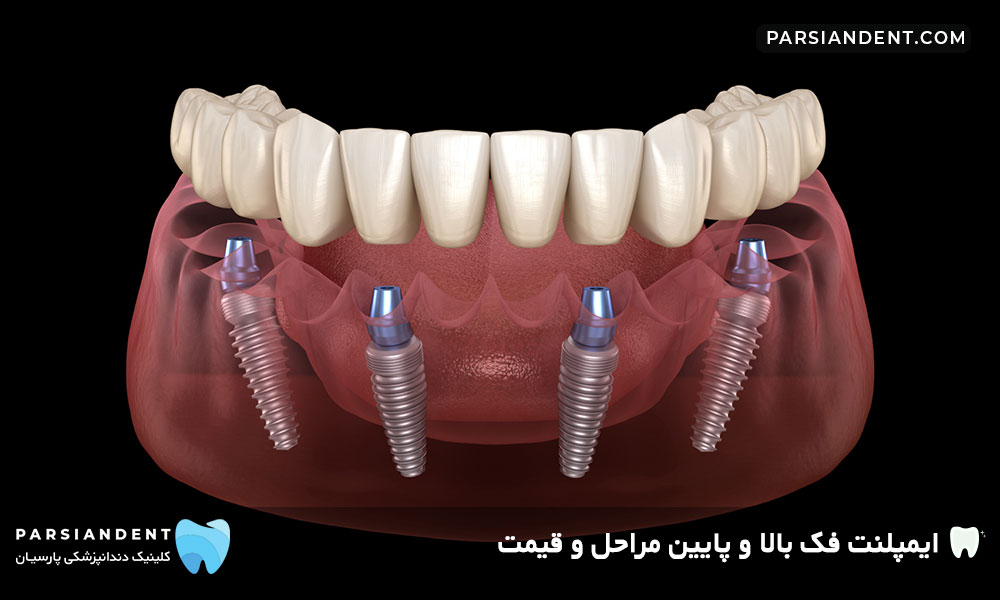 ایمپلنت فک بالا و پایین
