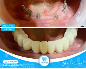 ایمپلنت دندان شرق تهران