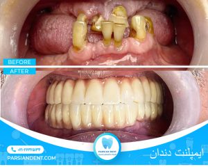 ایمپلنت دندان شرق تهران