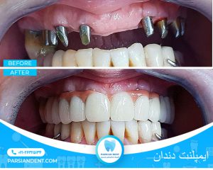ایمپلنت دندان تهران