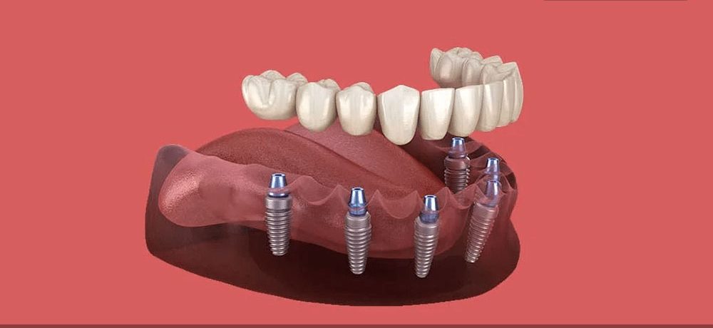 لق شدن ایمپلنت دندان