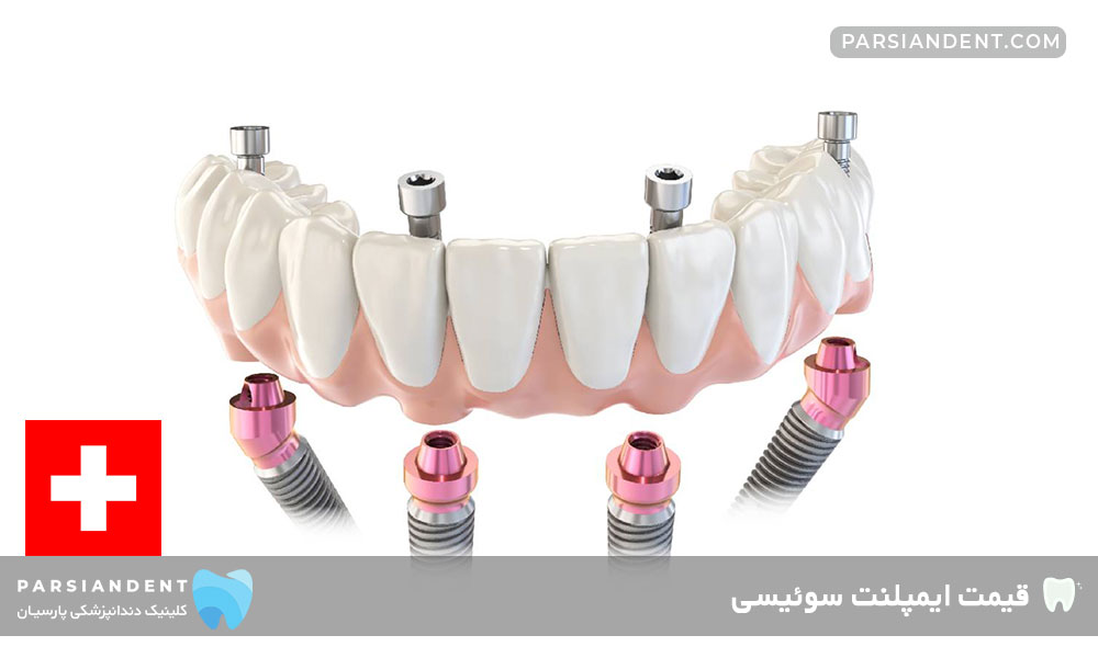 قیمت ایمپلنت سوئیسی