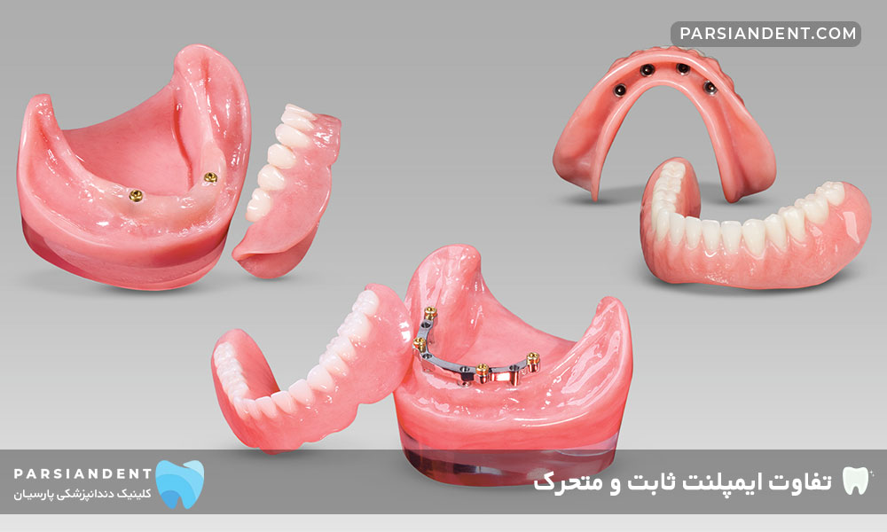 تفاوت ایمپلنت ثابت و متحرک