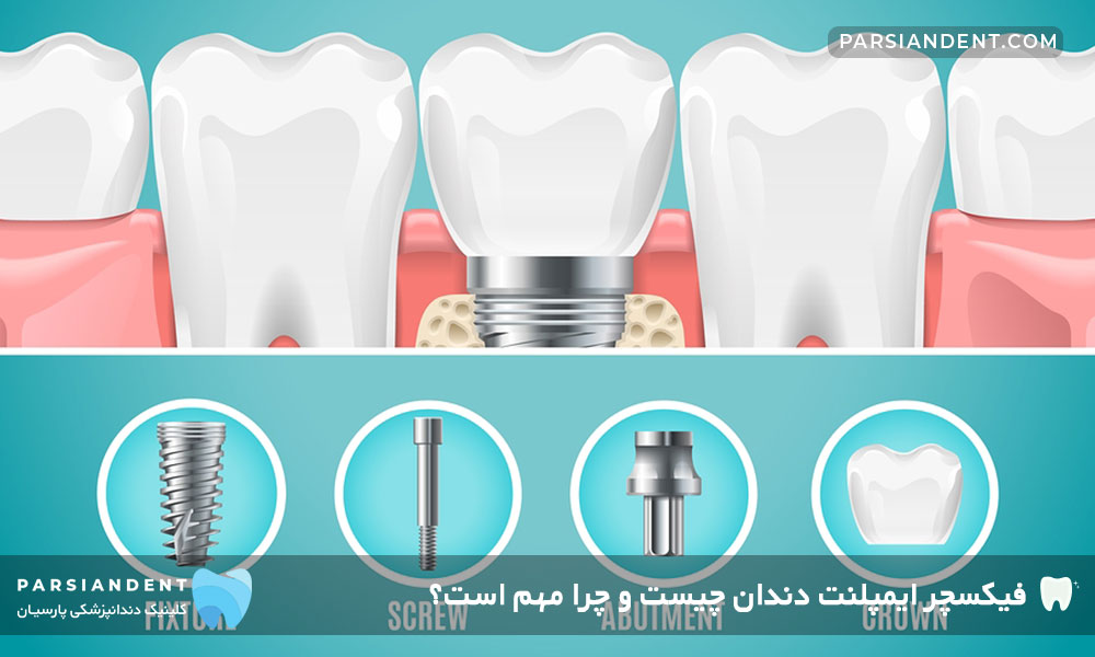 فیکسچر ایمپلنت دندان