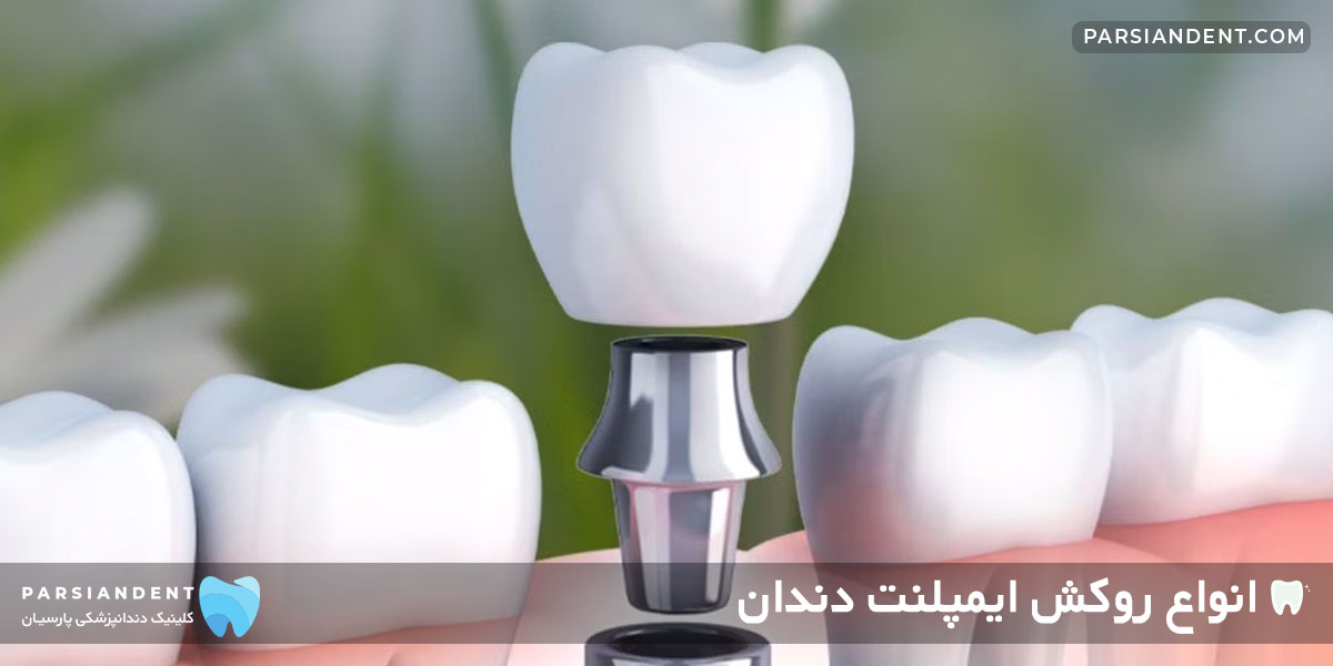 انواع روکش ایمپلنت دندان