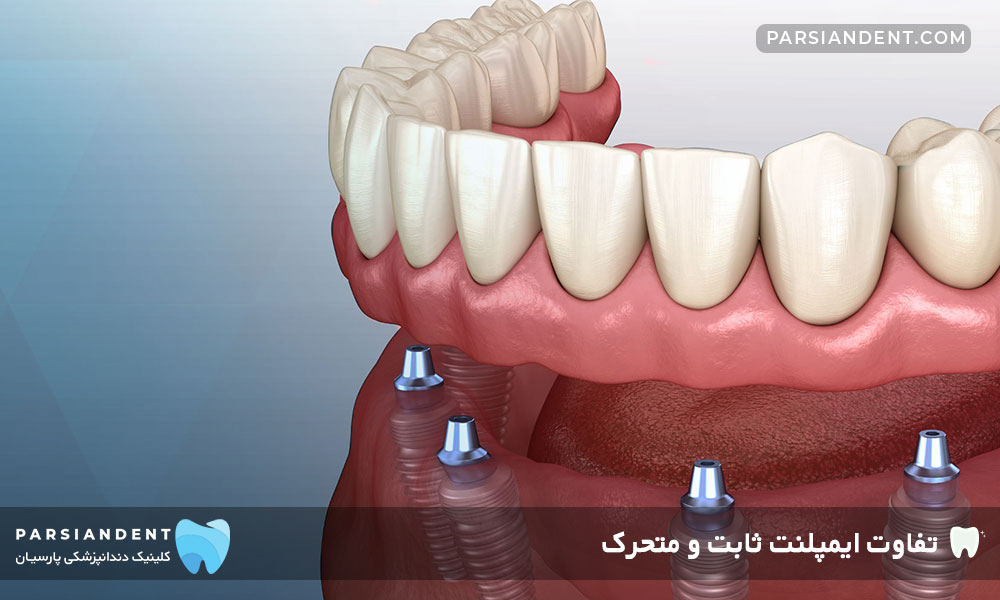 ایمپلنت ثابت و متحرک