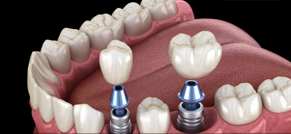 دلایل لق شدن ایمپلنت دندان
