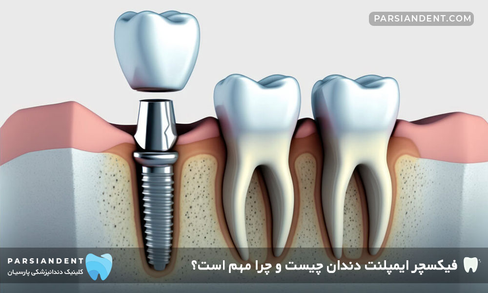 انواع فیکسچر ایمپلنت دندان