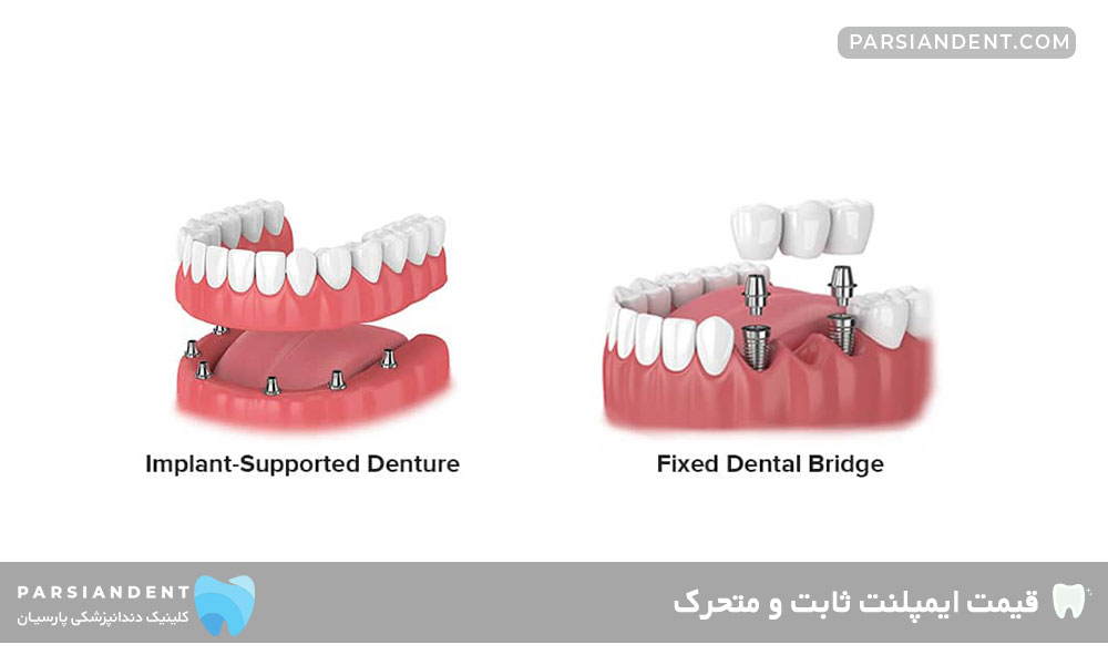 قیمت ایمپلنت ثابت و متحرک