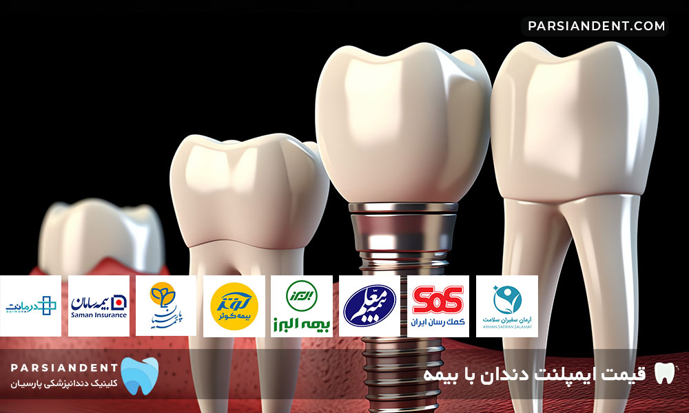 قیمت ایمپلنت دندان با بیمه
