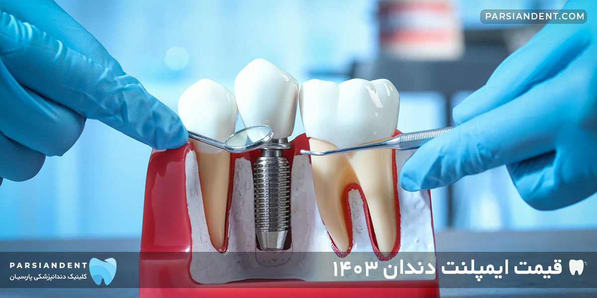 قیمت ایمپلنت دندان ۱۴۰۳