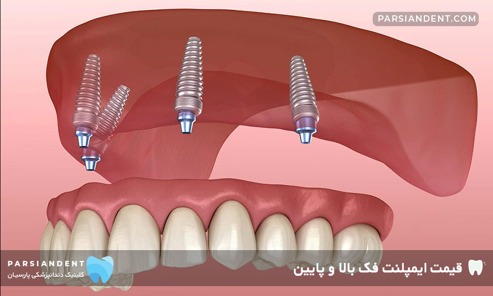 قیمت ایمپلنت فک بالا و پایین